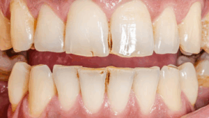 Extrinsic Discoloration 