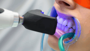 What is Teeth Whitening