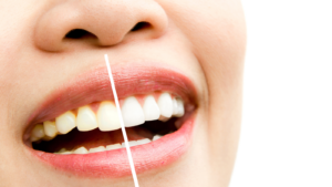 How Does Professional Whitening Treatment Work? 