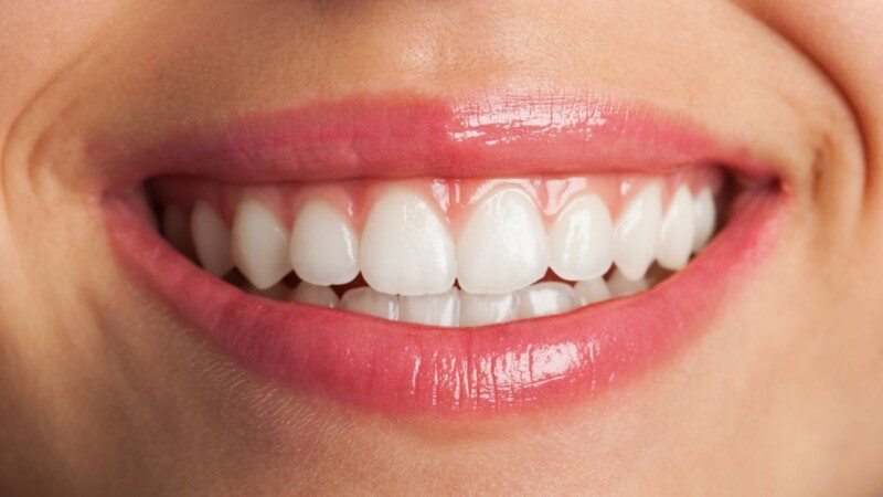 veneers Natural-looking veneers